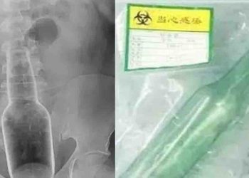 खुजली करने में हुई चूक, मलद्वार में  घुसी 7 इंच की बोतल