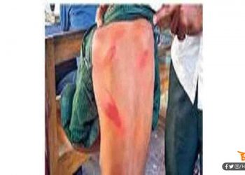 चप्पल पहन कर नहीं गई थी स्कूल : मास्टर साहेब ने 6 साल की बच्ची को पीट-पीटकर कर दिया अधमरा
