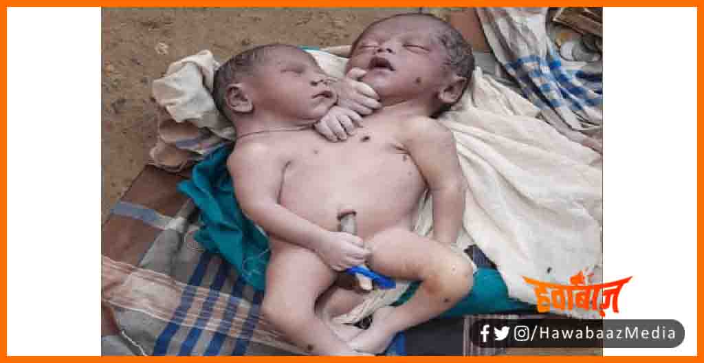 Bhagalpur me adbhut bachhe ka jnm, Bhagalpur me jnma adbhut bachha, azab gazab, Bhagalpur news, Bihar news, Bihar update, Bihar lettest update,